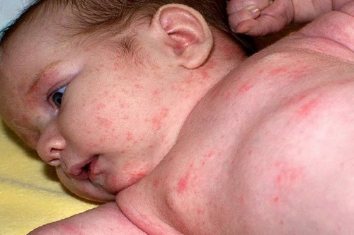 حساسية الجلد عند الطفل.. الأسباب و الأعراض